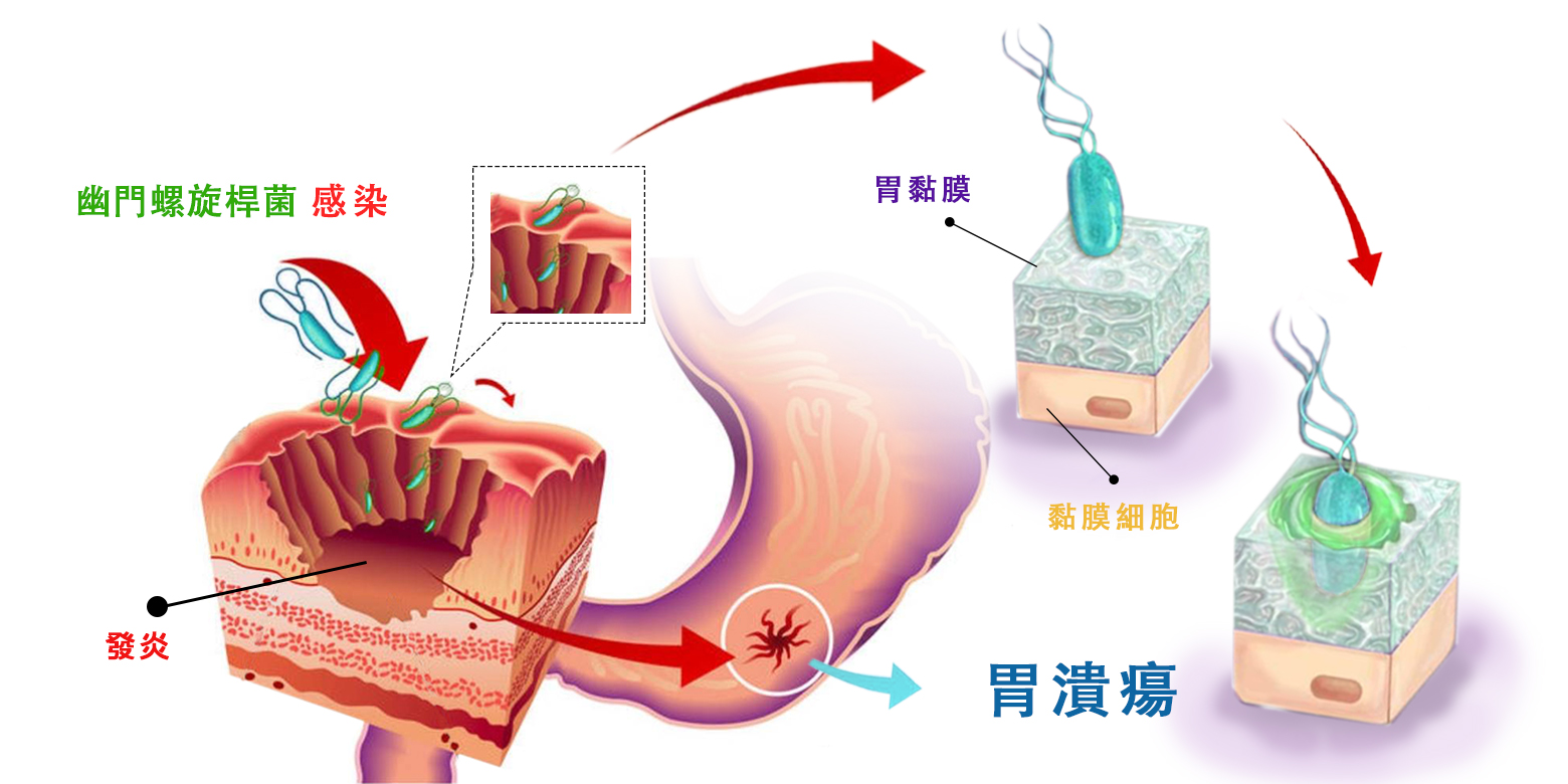 幽門螺旋桿菌可能是伴您一生的敵人| 李宜霖胃腸肝膽科