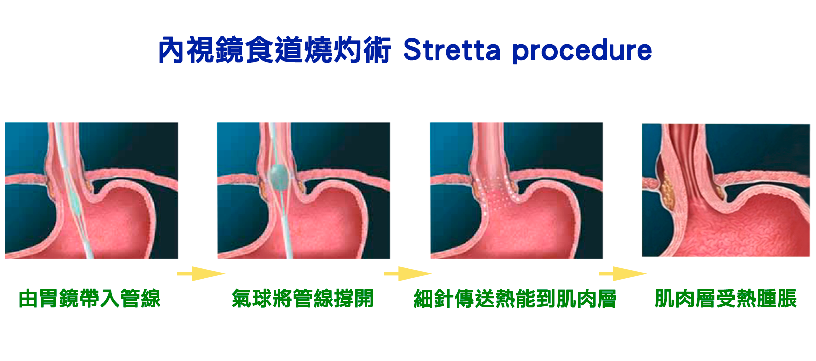 射頻電燒灼術 Radiofrequency Stretta Procedures 治療胃食道逆流 下 李宜霖胃腸肝膽科