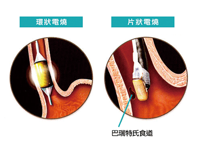 巴瑞特氏食道 Barrett S Esophagus Be 胃食道逆流 食道癌前病變 食道腺癌 李宜霖胃腸肝膽科