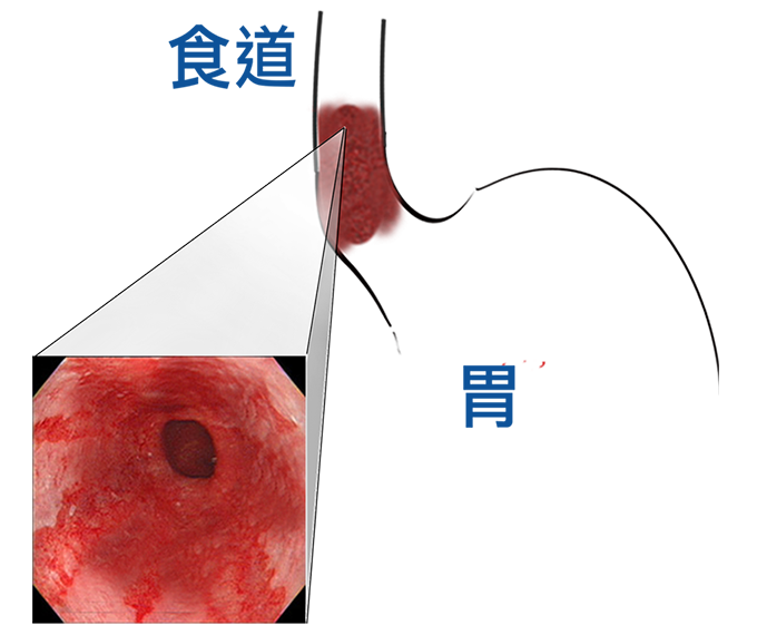 巴瑞特氏食道 Barrett S Esophagus Be 胃食道逆流 食道癌前病變 食道腺癌 李宜霖胃腸肝膽科