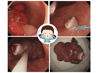 大腸鏡 瘜肉 李宜霖診所 大腸鏡檢查 大腸鏡分享文 李宜霖胃腸肝膽科