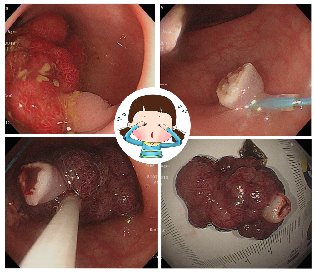 大腸鏡 瘜肉 李宜霖診所 大腸鏡檢查 大腸鏡分享文 李宜霖胃腸肝膽科