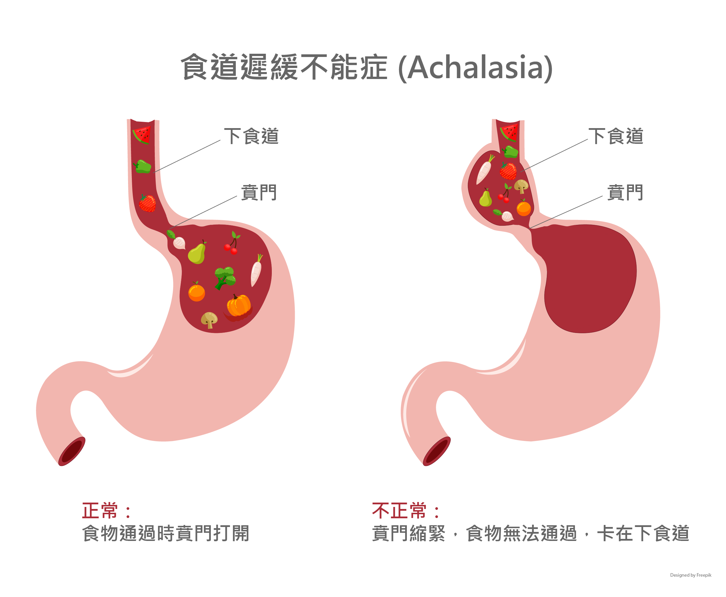 食道賁門弛緩不能症 Achalasia 李宜霖胃腸肝膽科