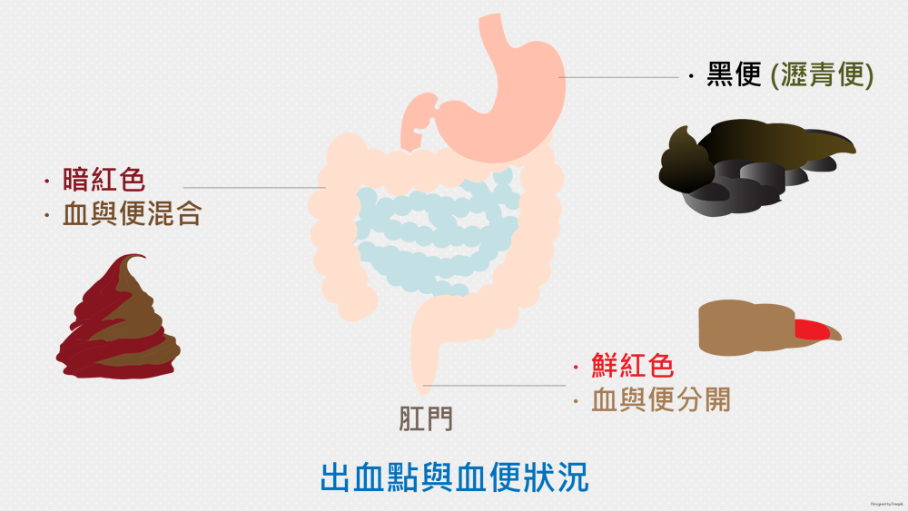 消化管出血治療 | 消化管出血 検査データ – OICEX