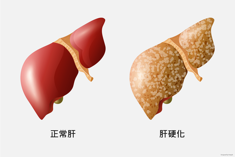 肝硬化 肝纖維化 李宜霖胃腸肝膽科