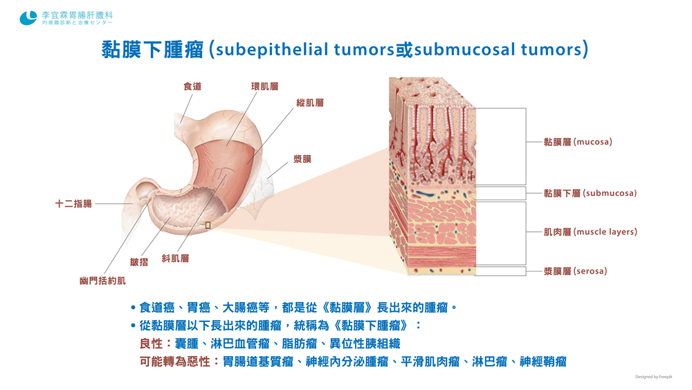 黏膜下腫瘤 黏膜層 Submucosal Tumors Sub Epithelial Tumors 李宜霖胃腸肝膽科