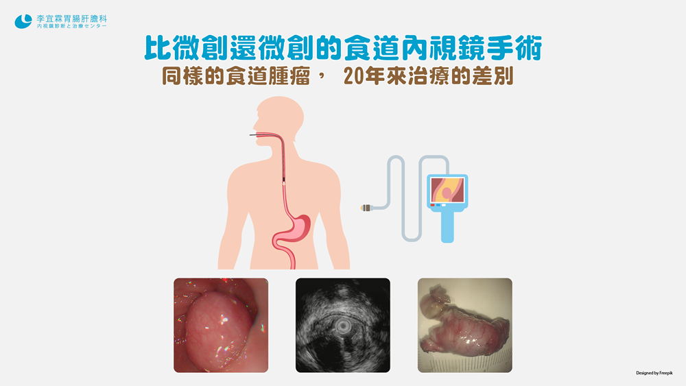 比微創還微創的食道內視鏡手術 李宜霖胃腸肝膽科