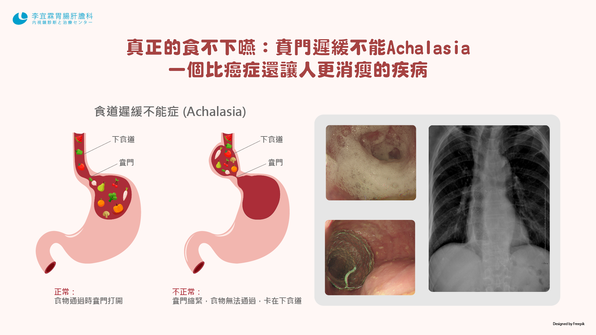 真正的食不下嚥 賁門遲緩不能achalasia 李宜霖胃腸肝膽科