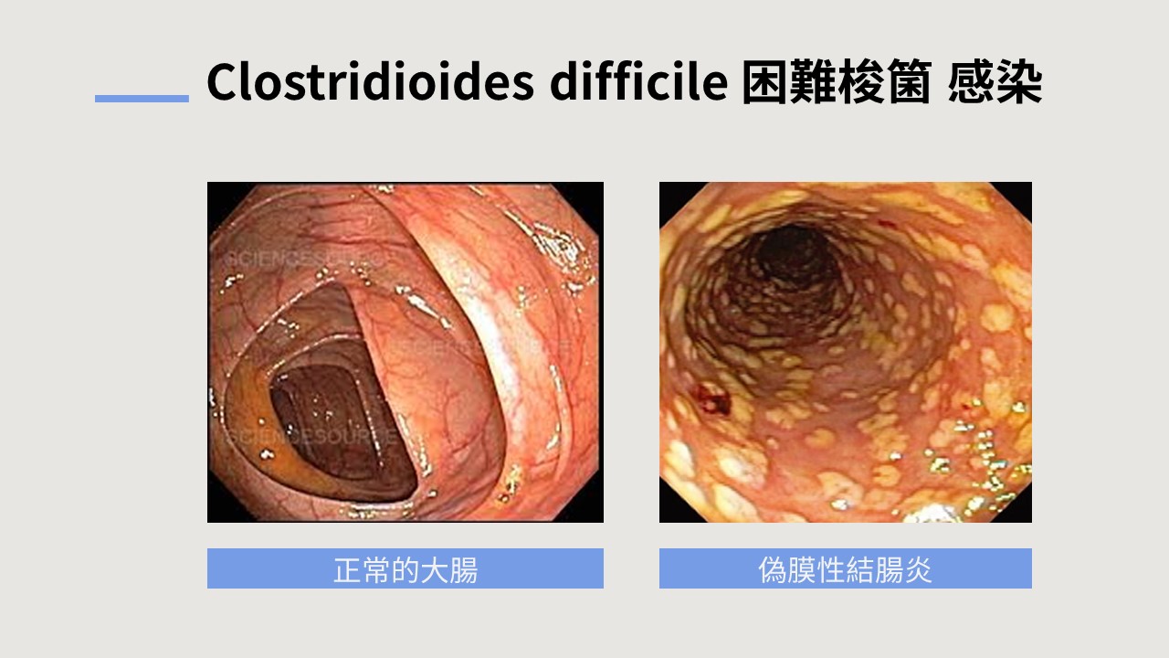 Clostridioides difficile 困難梭箘 感染